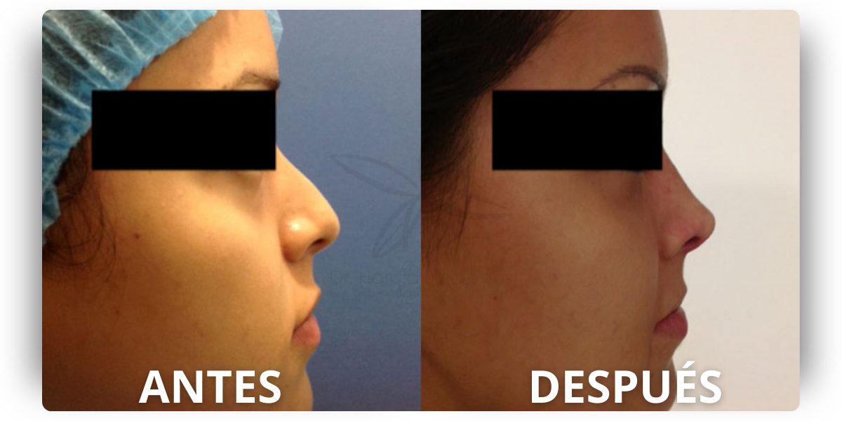 dr-Harold-Villalobos-rinoplastia (2)