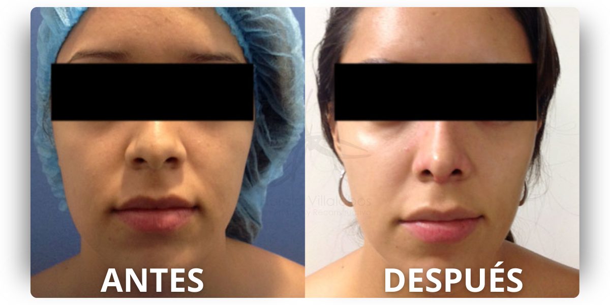 dr-Harold-Villalobos-rinoplastia (21)