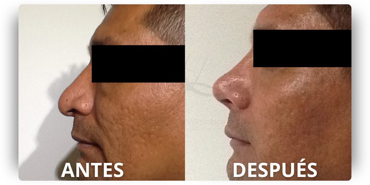 dr-Harold-Villalobos-rinoplastia (29)