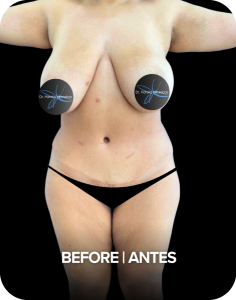 ANTES-#2