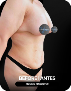 ANTES#1