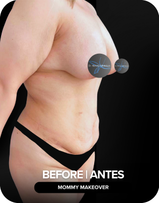ANTES#1